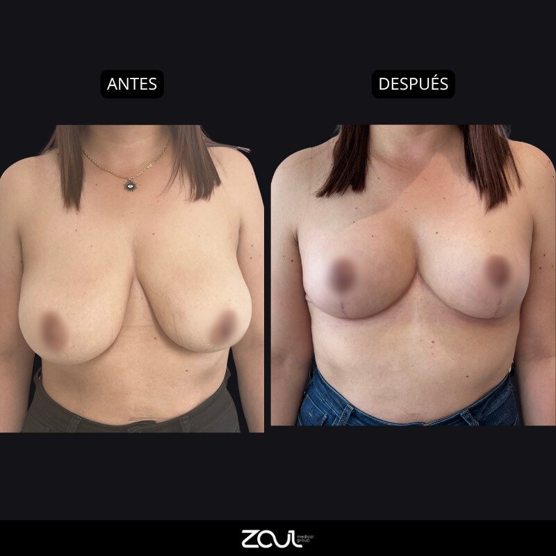 Mamoplastia de reducción - Dra Carolina Hoyos
