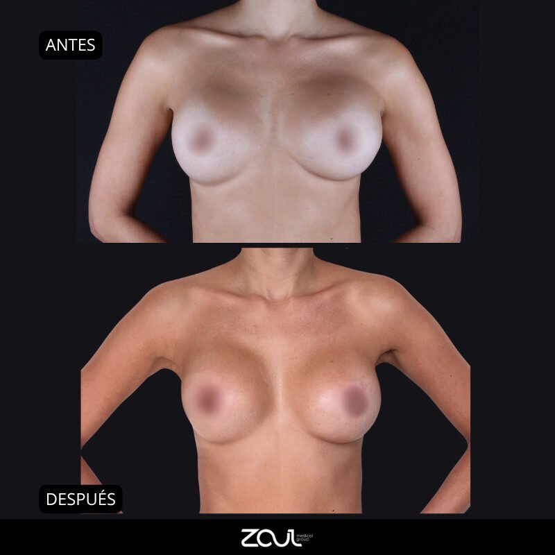Mastopexia (lifting mamario o levantamiento) - Dra Carolina Hoyos