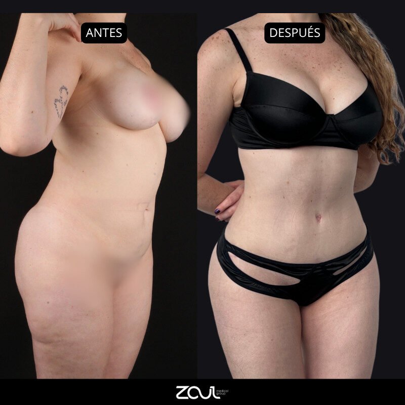 Lipoabdominoplastia - Dra Carolina Hoyos