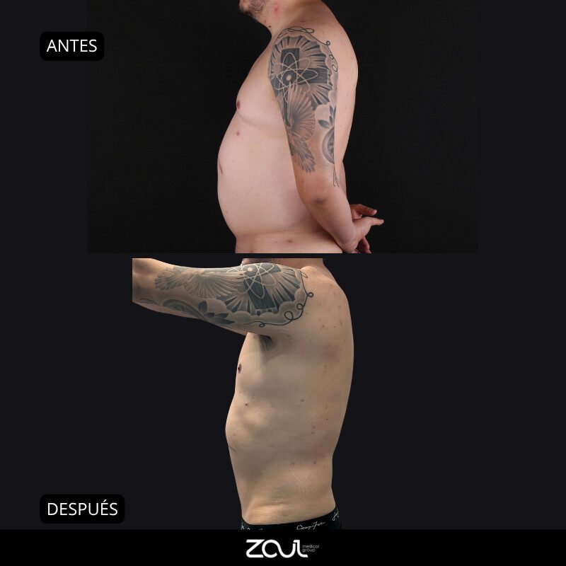 Abdominoplastia (reconstrucción de pared abdominal) - Dra Carolina Hoyos