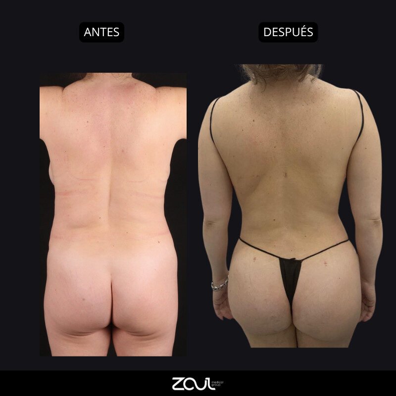 Mommy makeover (mastopexia + lipoabdominoplastia) - Dra Carolina Hoyos