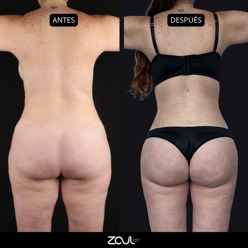 Lipoabdominoplastia - Dra Carolina Hoyos