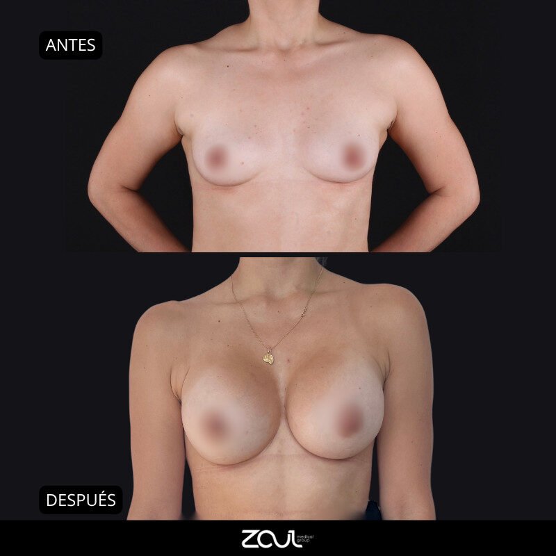 Mamoplastia de aumento con implantes redondos - Dra Carolina Hoyos
