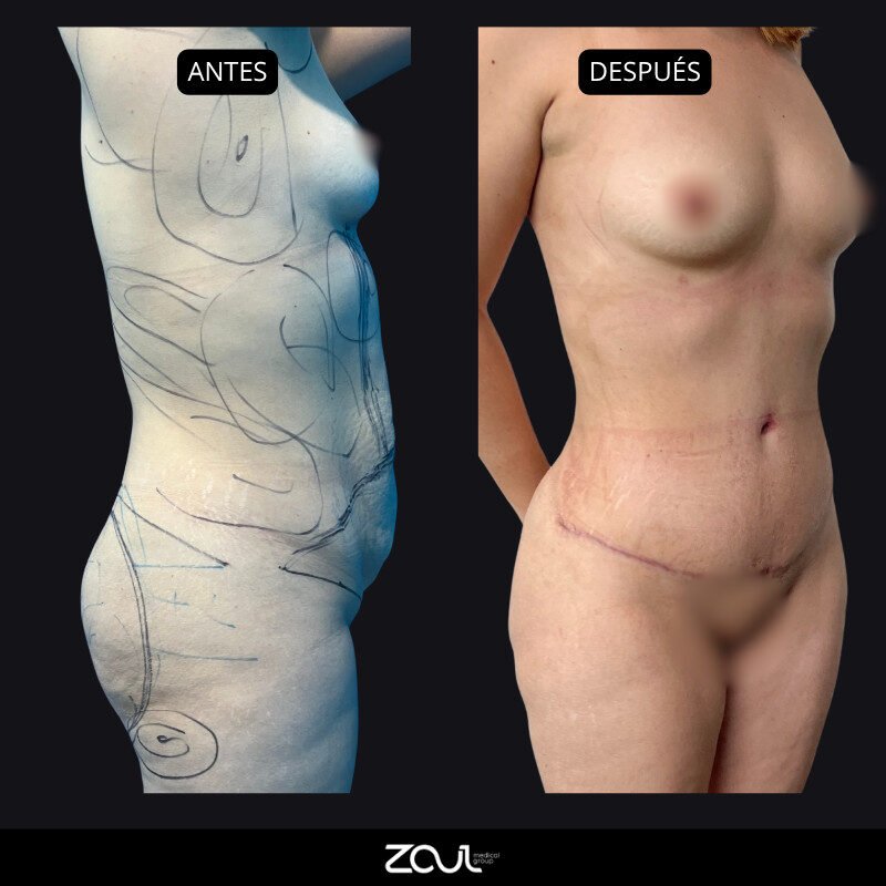 Lipoabdominoplastia - Dra Carolina Hoyos