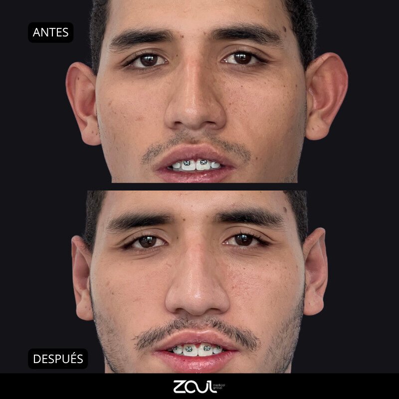 Otoplastia - Dra Carolina Hoyos