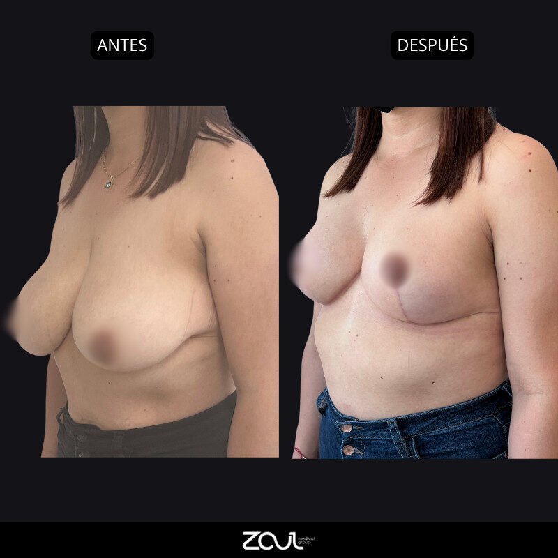 Mamoplastia de reducción - Dra Carolina Hoyos