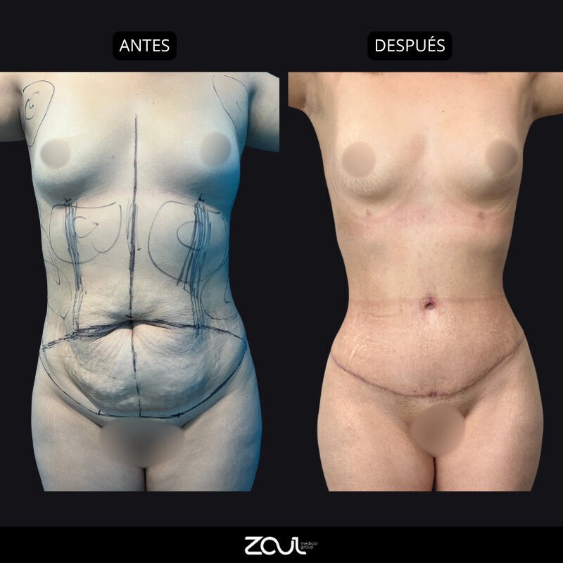 Lipoabdominoplastia - Dra Carolina Hoyos
