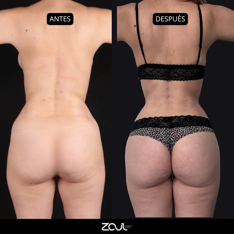 Lipoescultura y lipotransferencia - Dra Carolina Hoyos