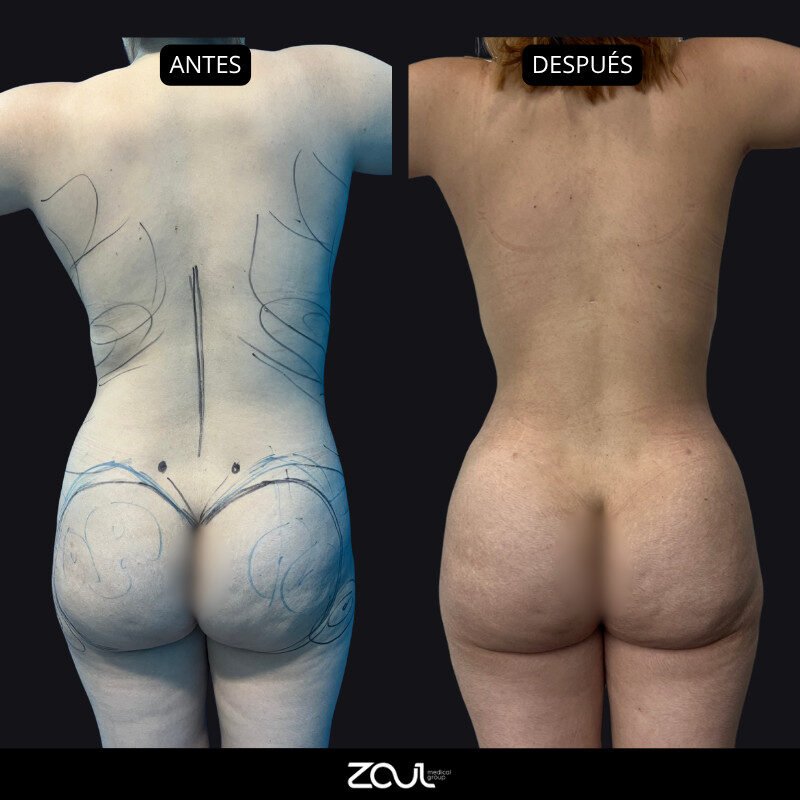 Lipoabdominoplastia - Dra Carolina Hoyos