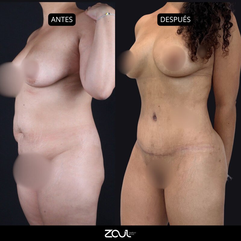 Lipoabdominoplastia - Dra Carolina Hoyos
