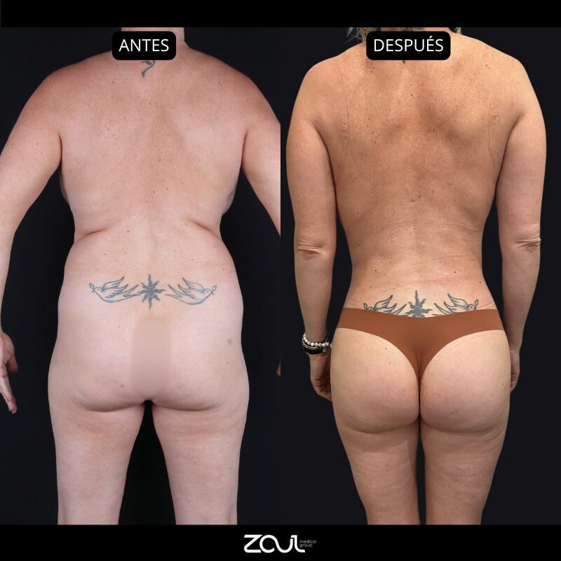 Mommy makeover (mastopexia + lipoabdominoplastia) - Dra Carolina Hoyos