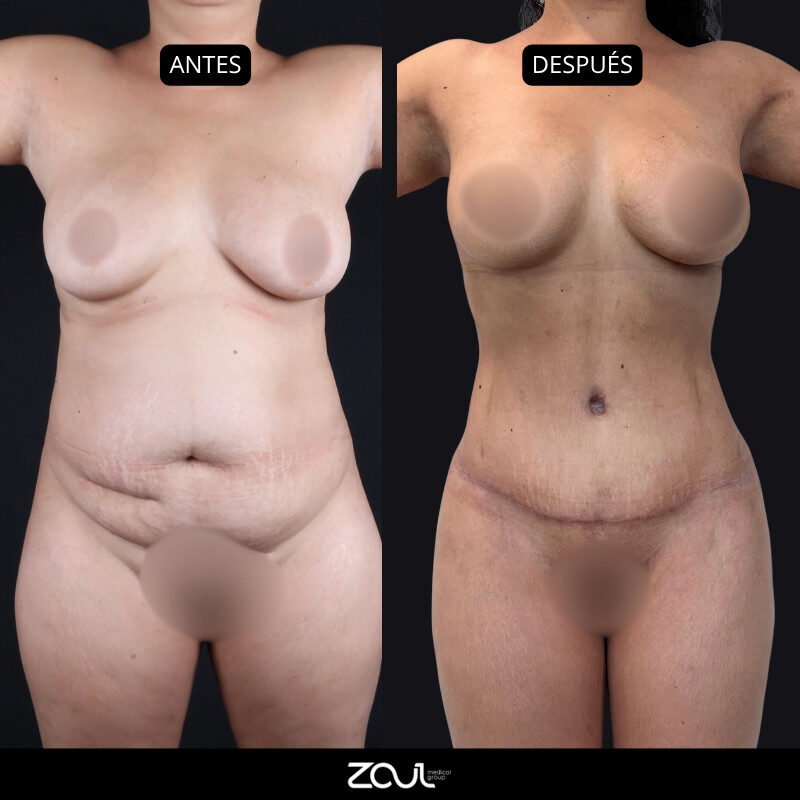 Lipoabdominoplastia - Dra Carolina Hoyos