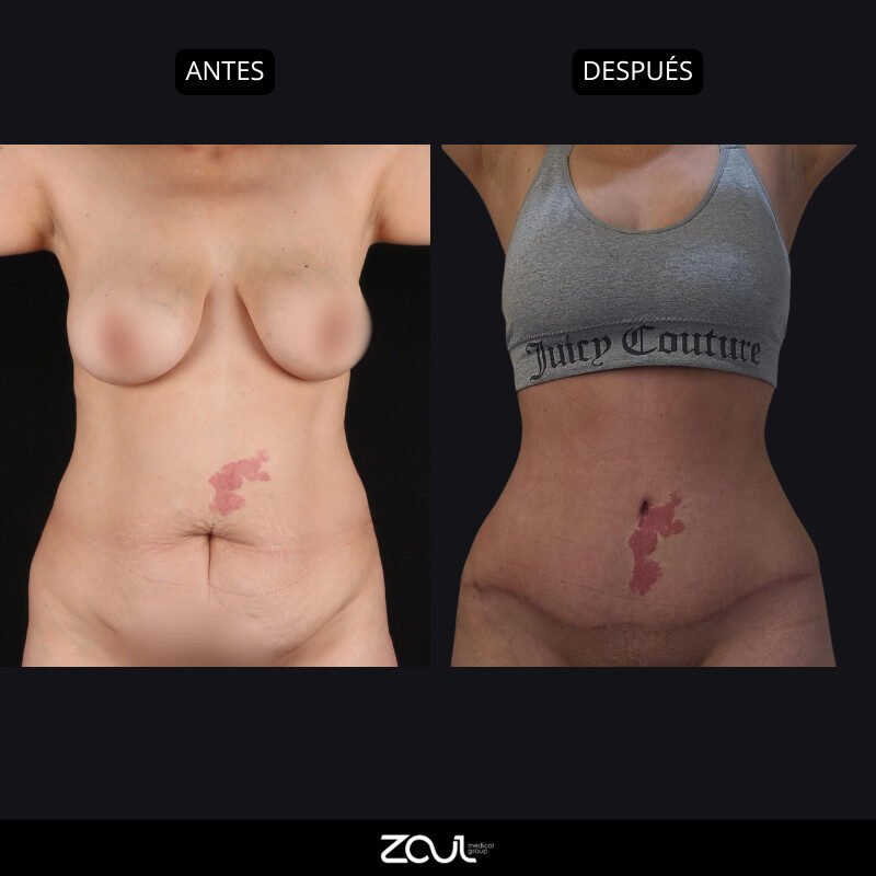 Lipoabdominoplastia - Dra Carolina Hoyos