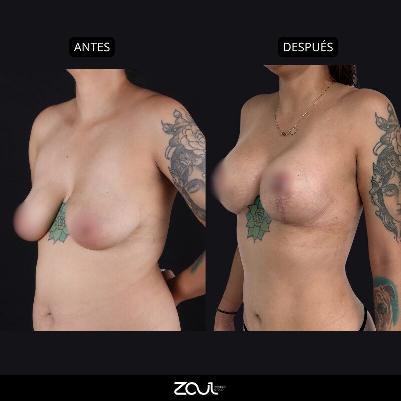 Mastopexia (lifting mamario o levantamiento) - Dra Carolina Hoyos
