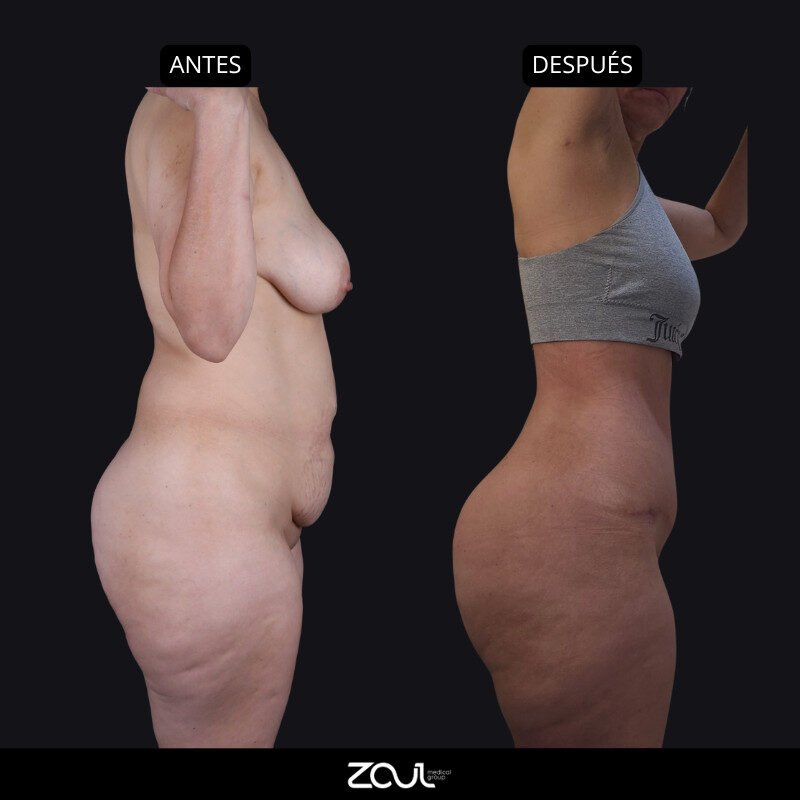 Lipoabdominoplastia - Dra Carolina Hoyos