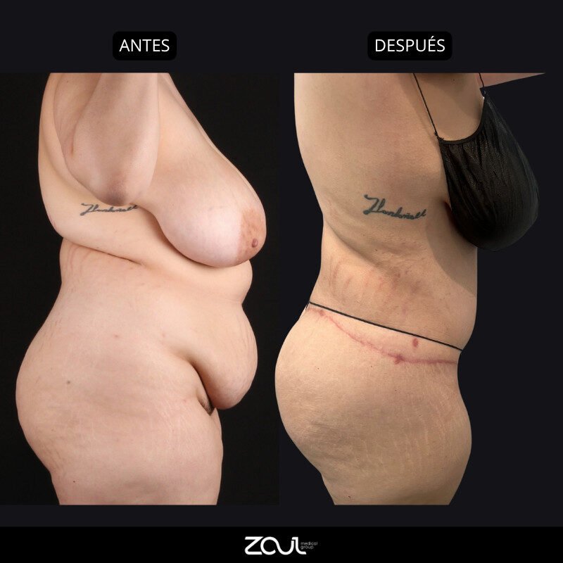 Lipoabdominoplastia - Dra Carolina Hoyos