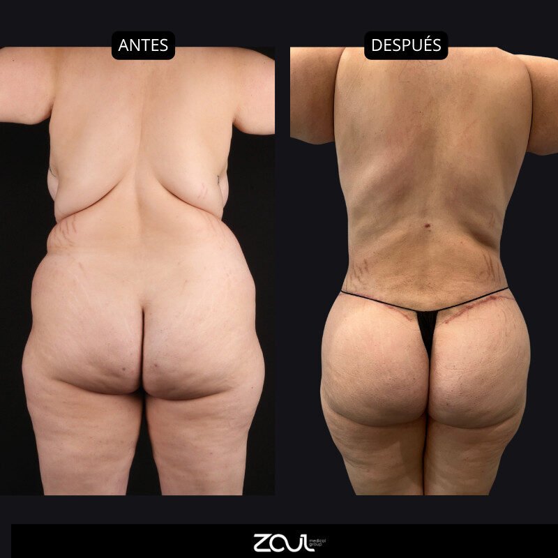 Lipoabdominoplastia - Dra Carolina Hoyos