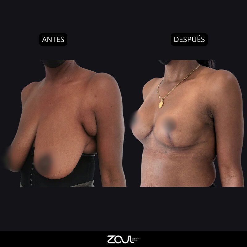 Mamoplastia de reducción - Dra Carolina Hoyos