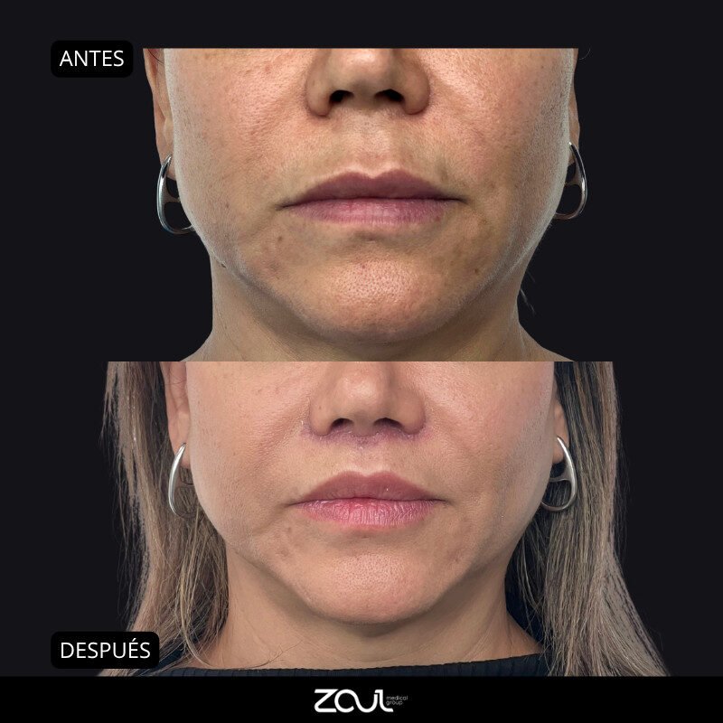Lifting de labios