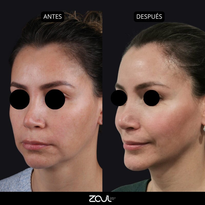 Lipoinyeccion en cara y mentoplastia