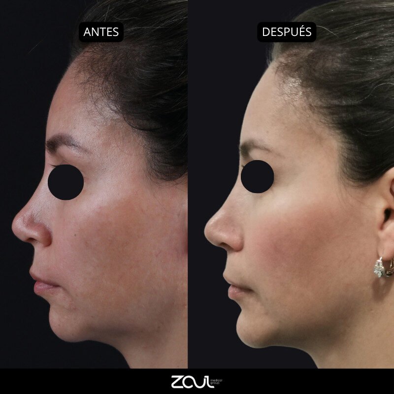 Lipoinyeccion en cara y mentoplastia